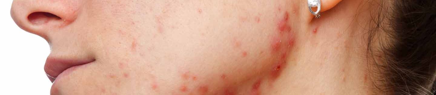 acne cistica