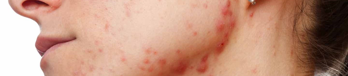 acne cistica