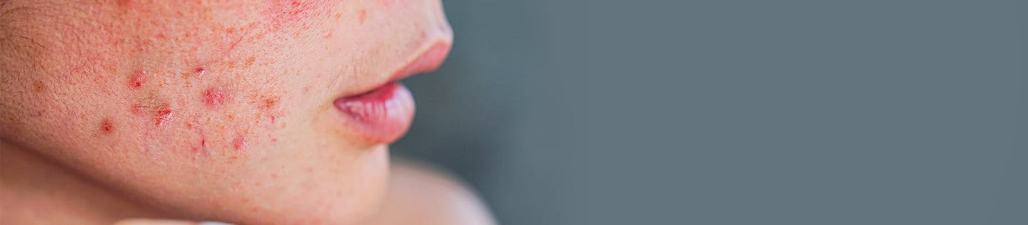 Acne giovanile