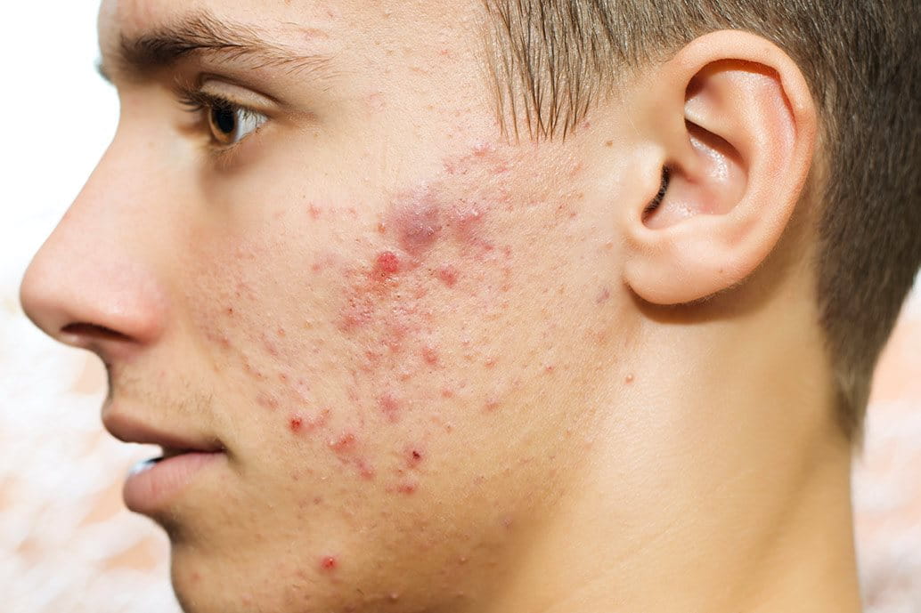 acne maschile