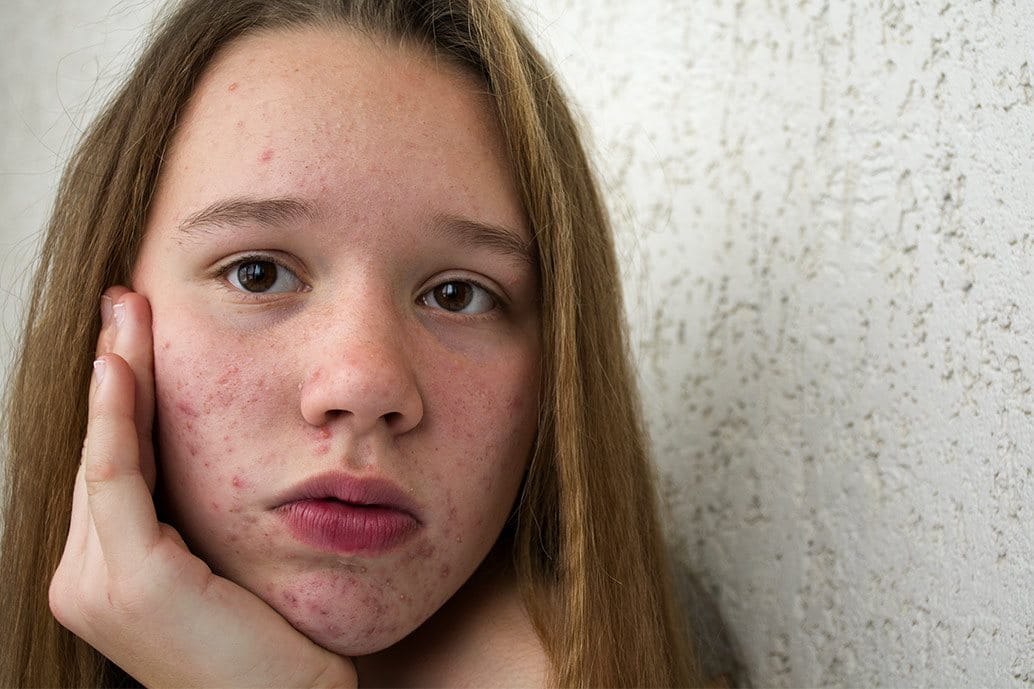 Acne giovanile a 10 anni