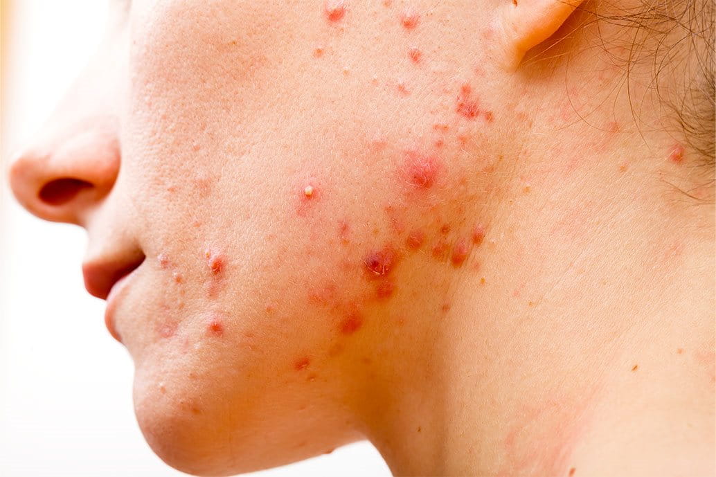 Acne a 11 anni