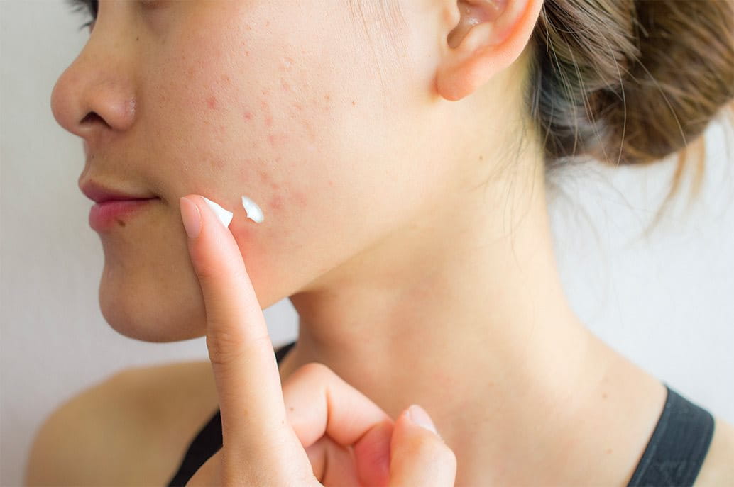 Crema contro acne giovanile