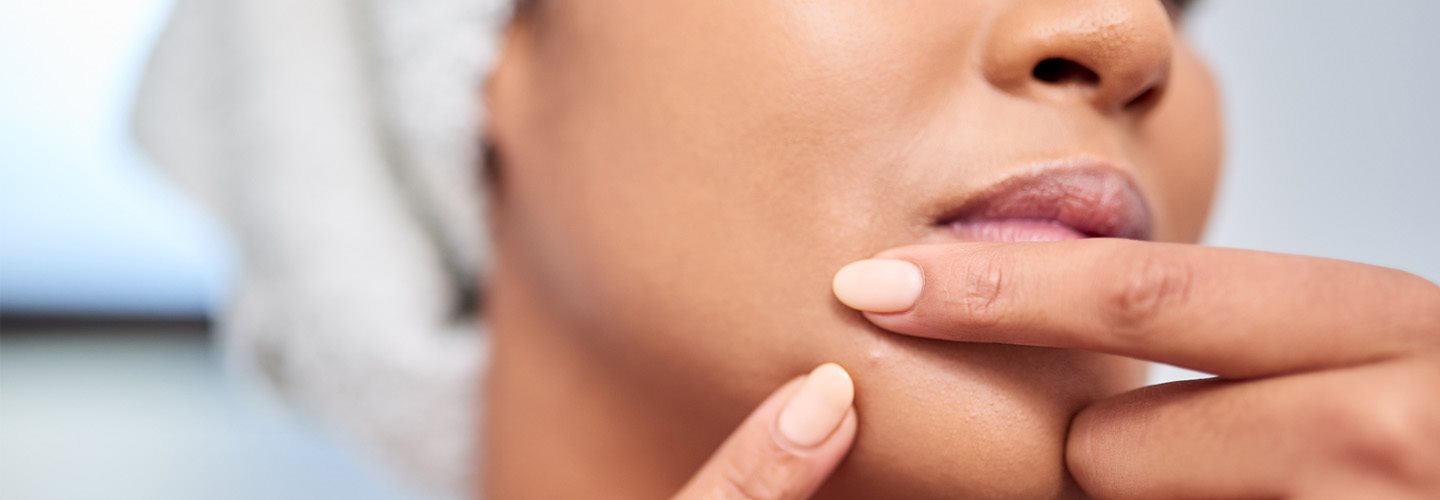 brufoli sul mento e collo