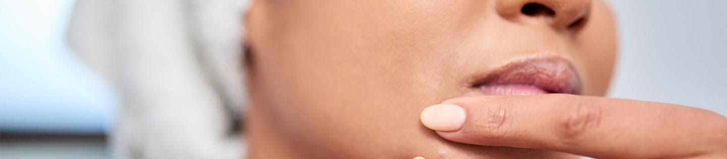 brufoli sul mento e collo