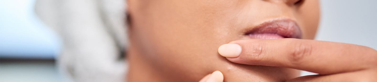 brufoli sul mento e collo