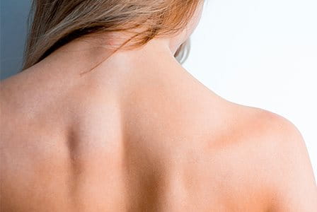 Brufoli sulla schiena