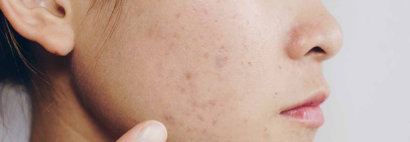 schiacciare i brufoli