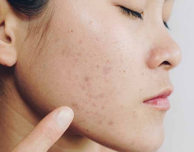 schiacciare i brufoli