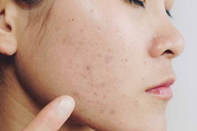 schiacciare i brufoli