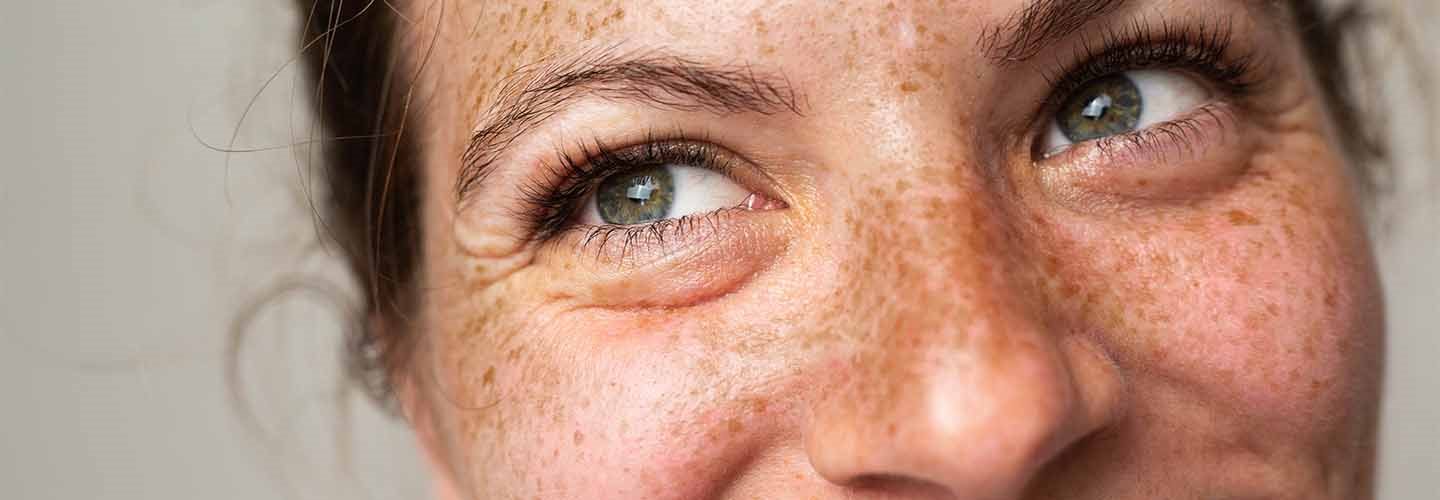 lentiggini e tipi di carnagione