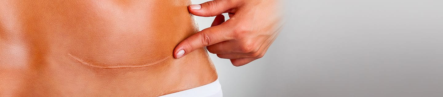 foto della cicatrice cheloide