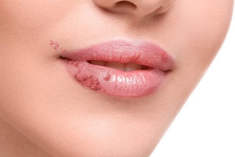 herpes sulle labbra