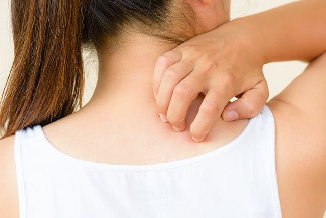 Orticaria da sudore