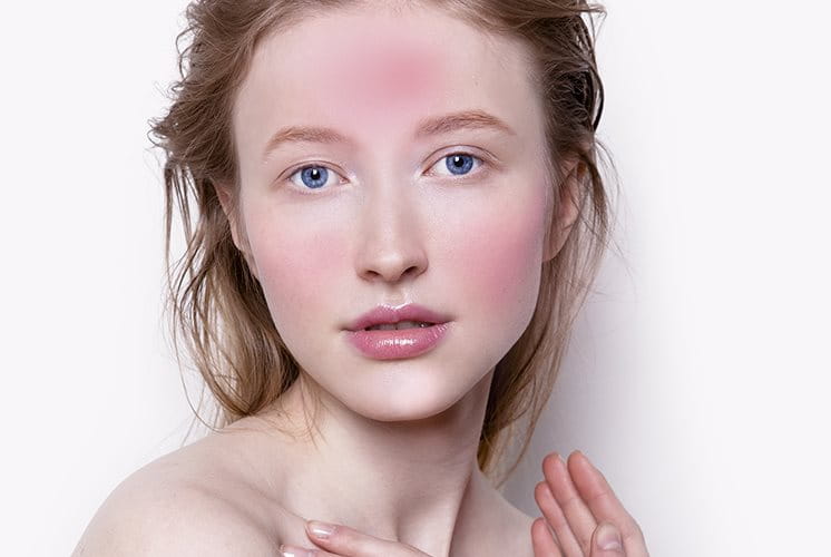 Pelle del viso irritata