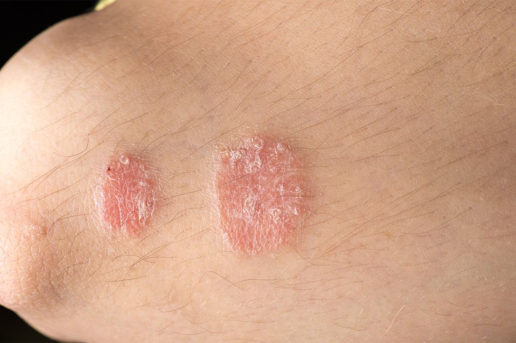 eczema nummulare immagini