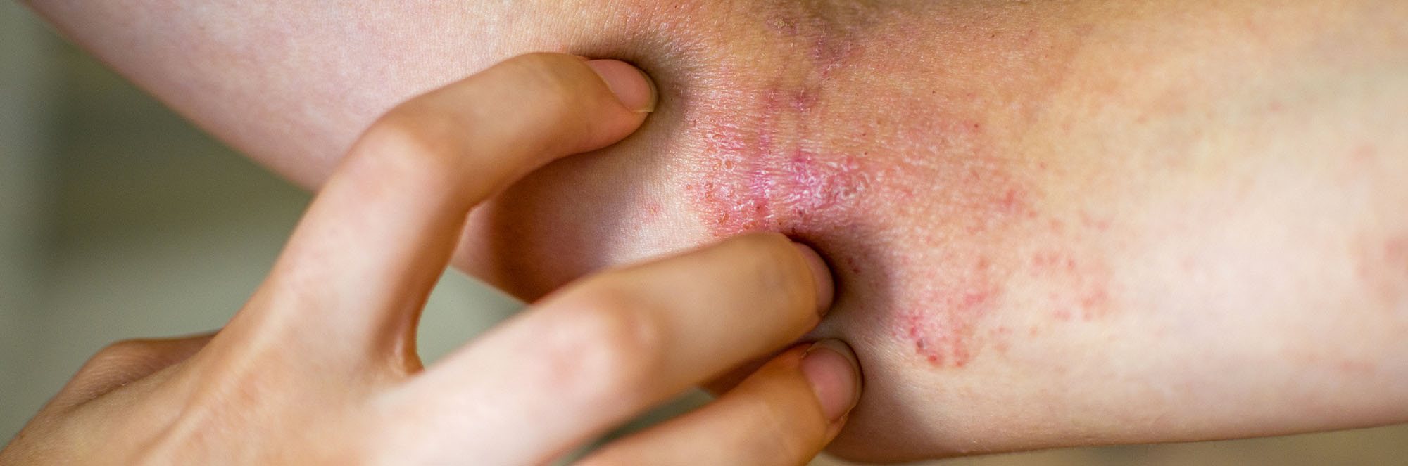 eczema nummulare