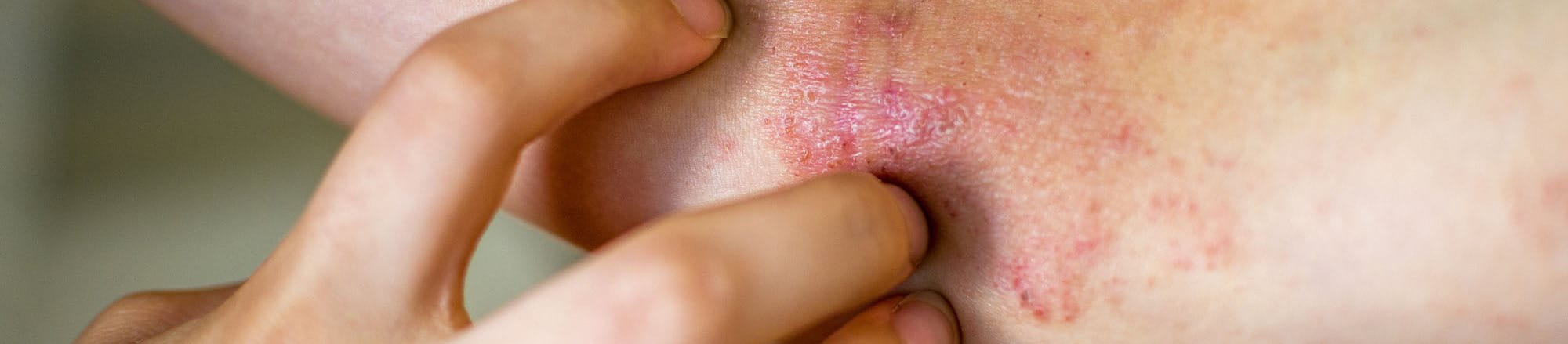eczema nummulare