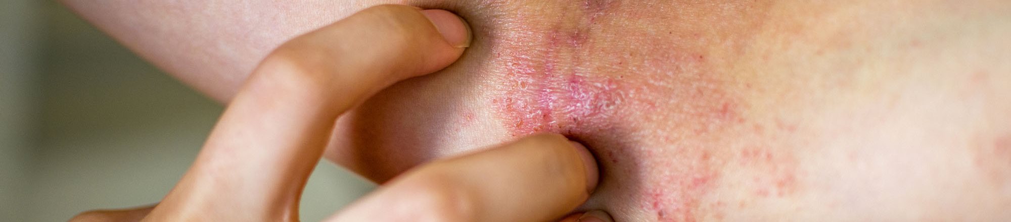 eczema nummulare