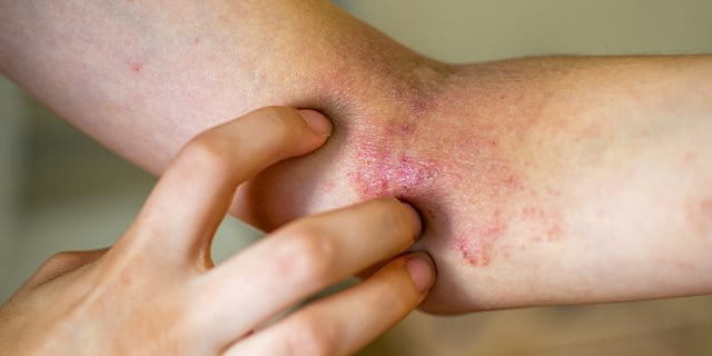  eczema nummulare