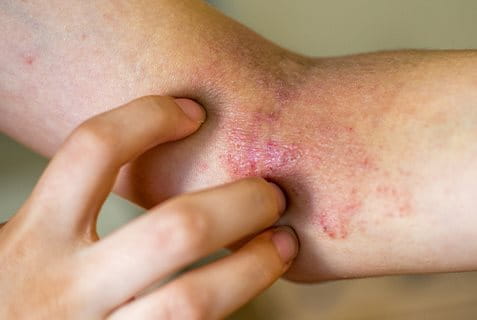 eczema nummulare