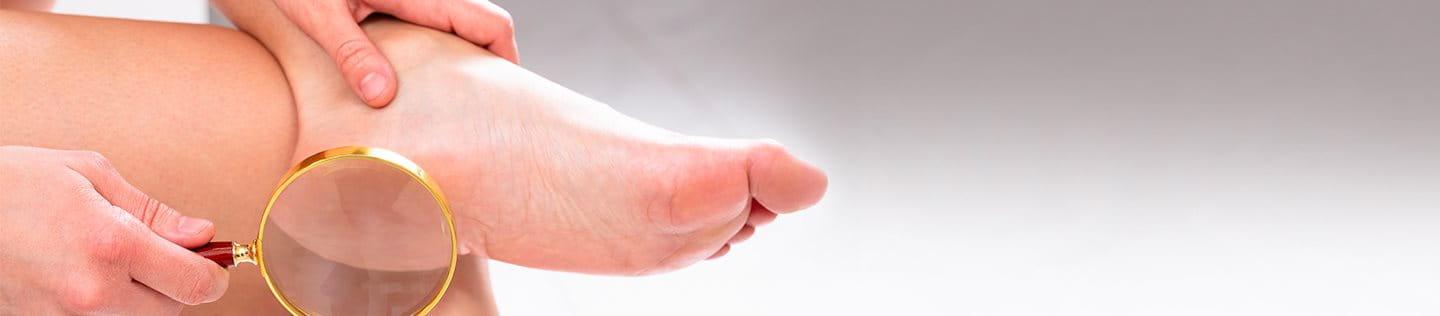 I duroni sono forme di ipercheratosi della pelle