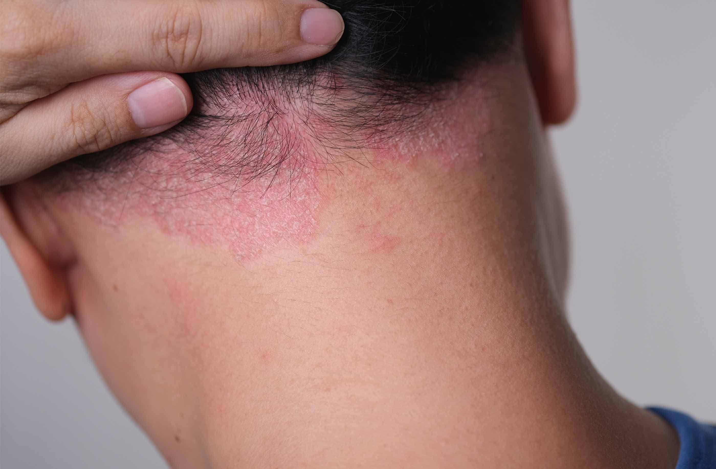 psoriasi cuoio capelluto immagini