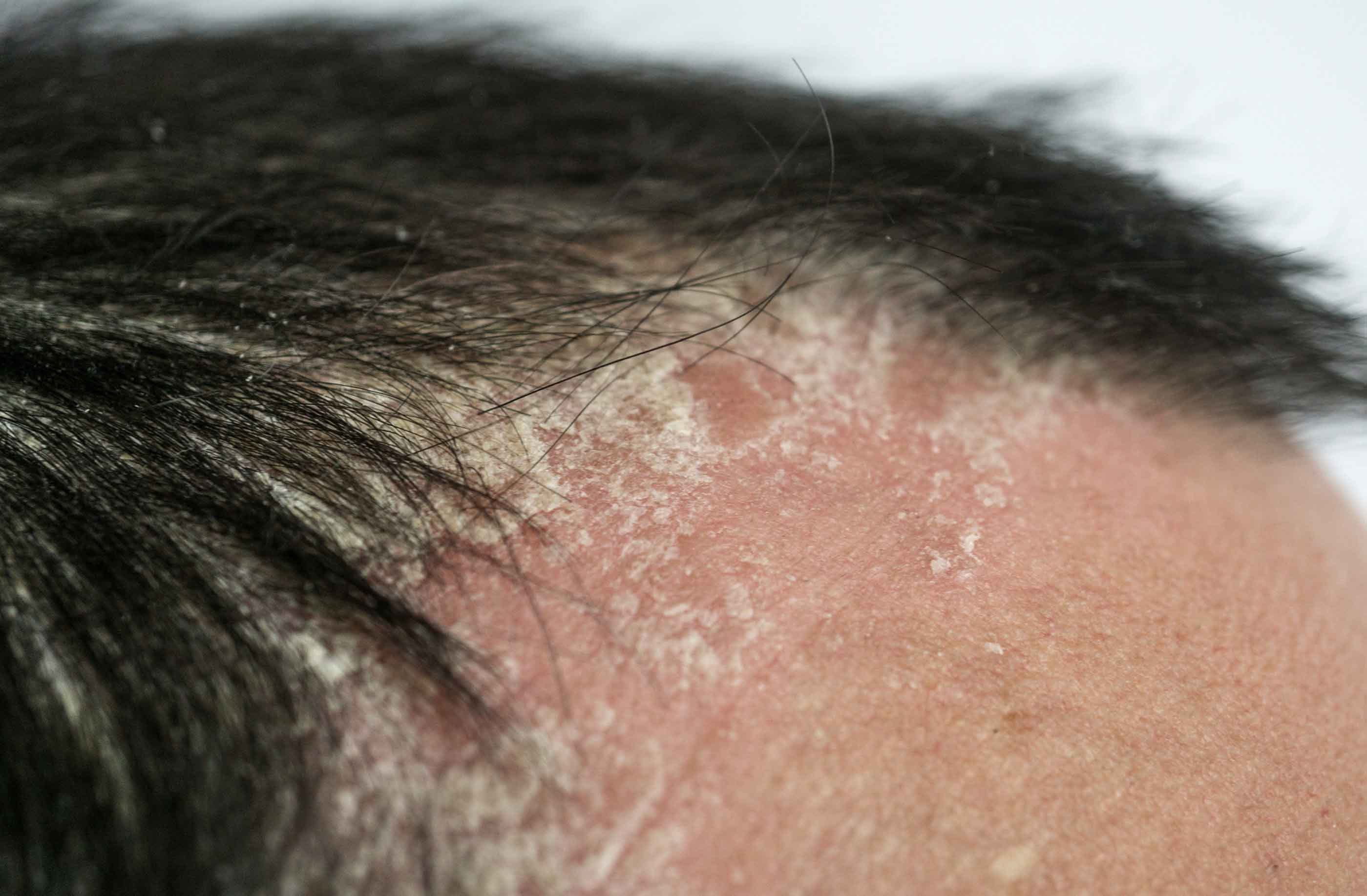 psoriasi capelli