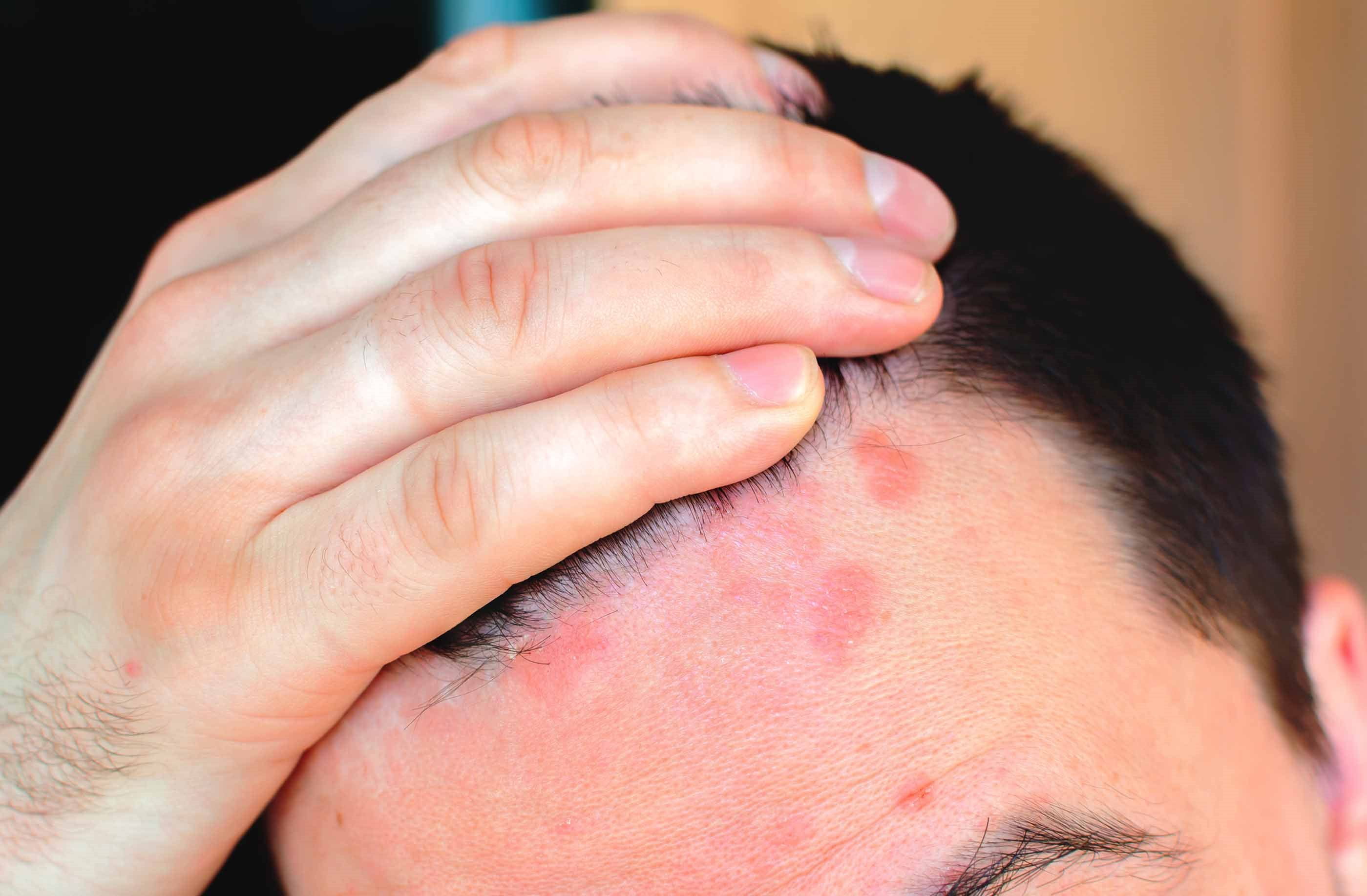 cuoio capelluto psoriasi 