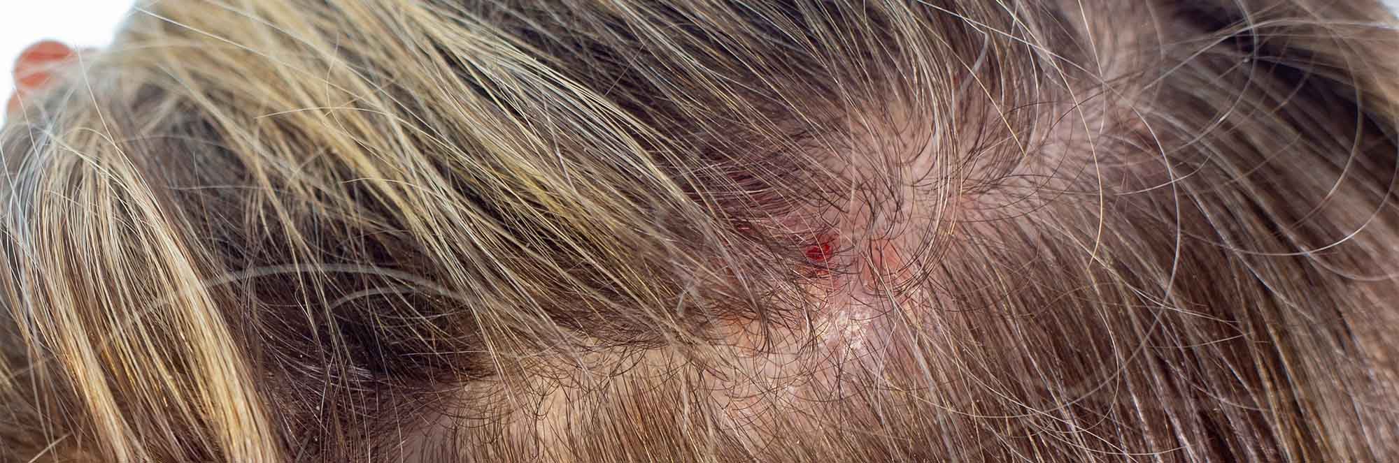 psoriasi cuoio capelluto