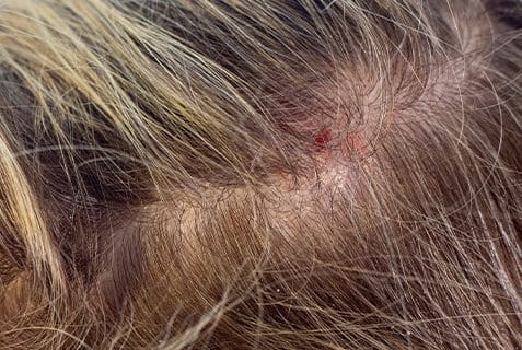 psoriasi cuoio capelluto