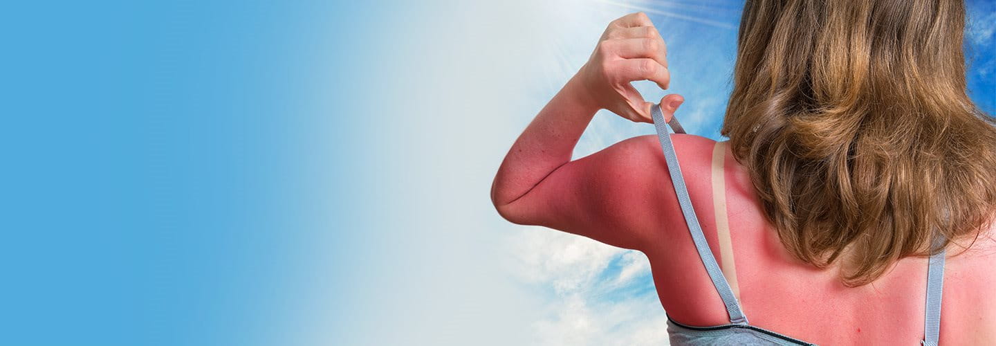 foto insolazione schiena