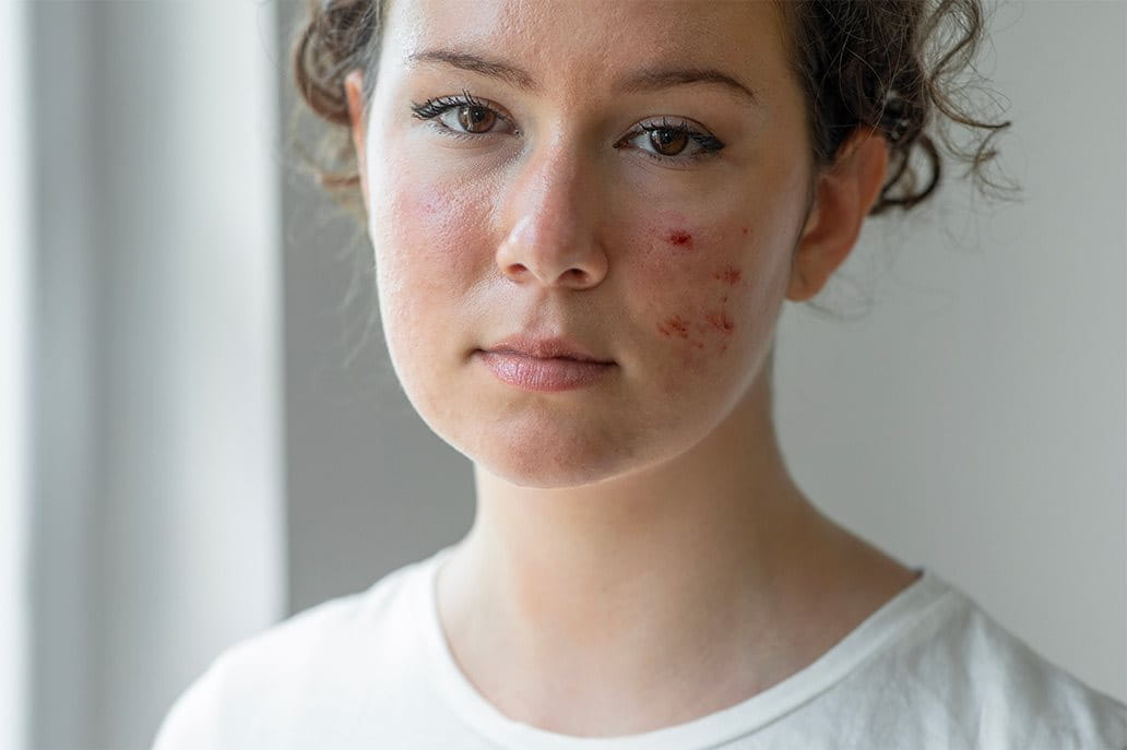 foto della dermatite atopica