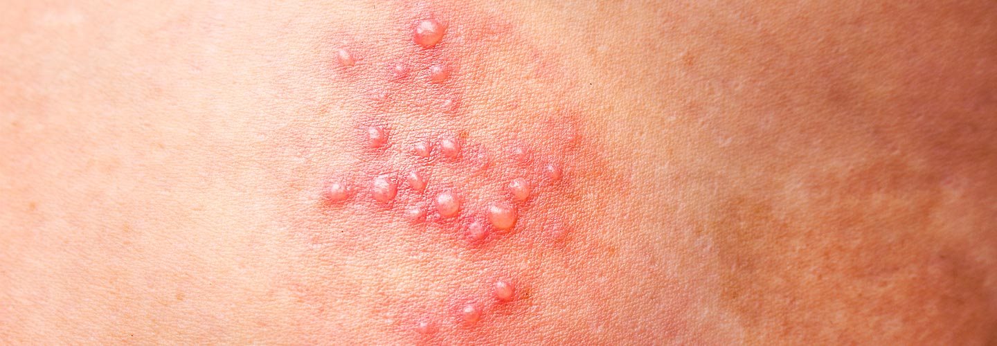 bolle sulla pelle immagini