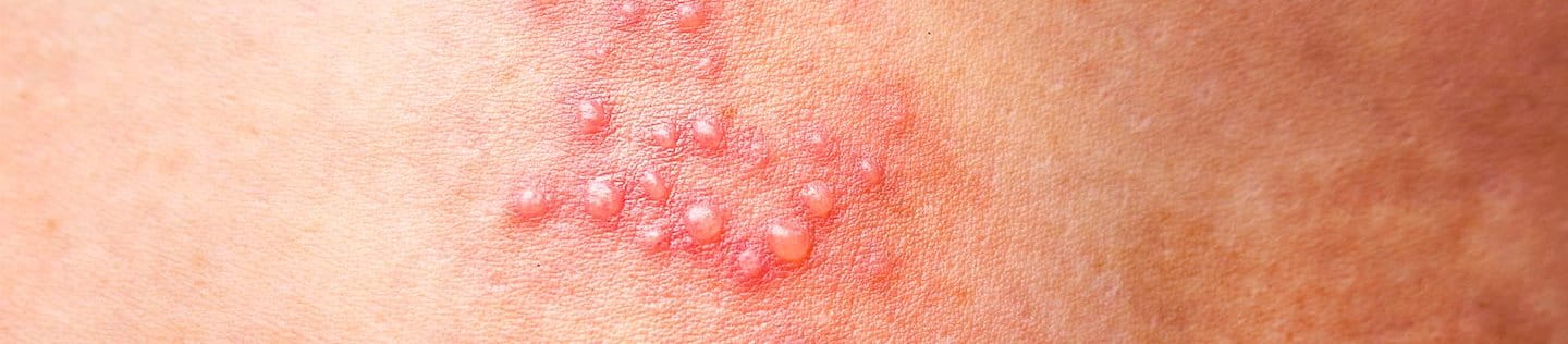 bolle sulla pelle immagini