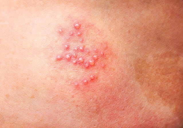Bolle sulla pelle: tutte le cause delle bolle cutanee - EUCERIN