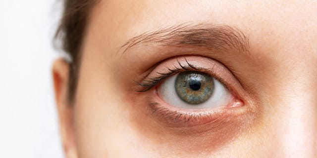 Occhiaie nere o scure