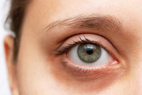 Occhiaie nere o scure