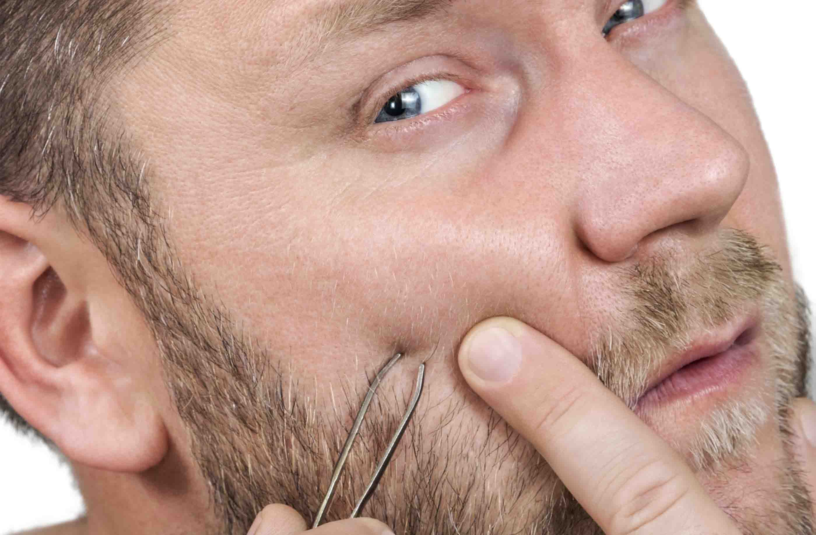 pelo incarnito sulla barba