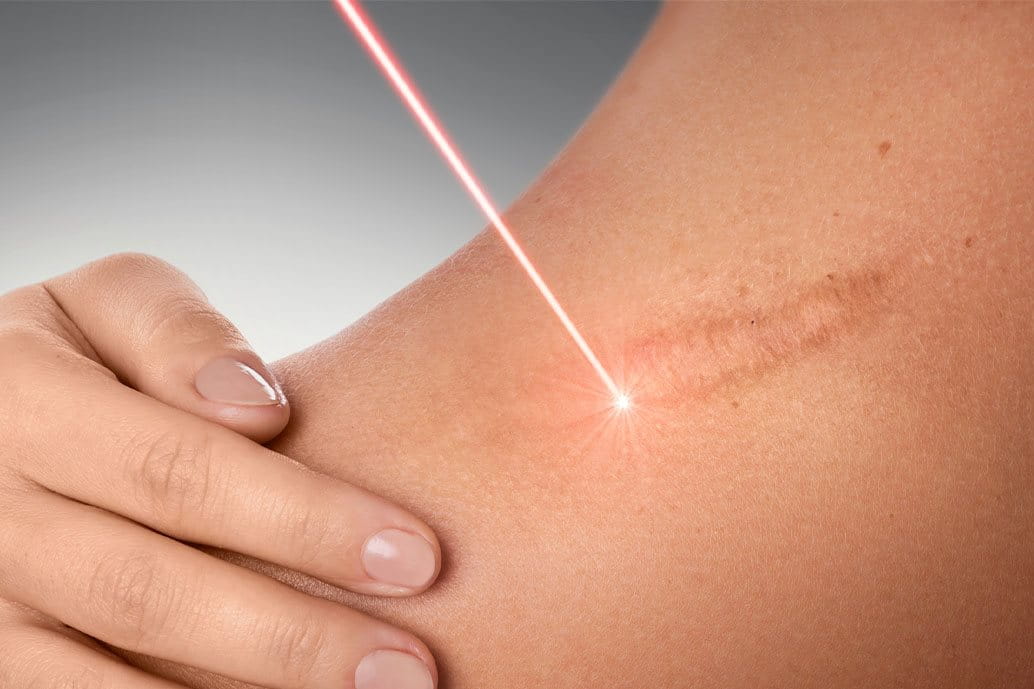 punti di sutura e laser