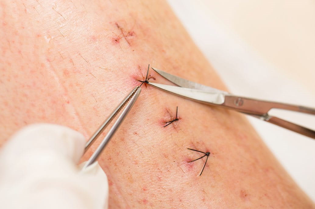foto della rimozione dei punti di sutura