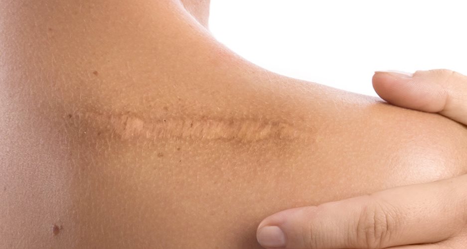 cicatrice post punti di sutura sulla spalla