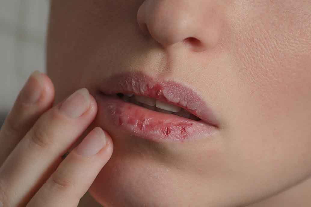 scrub per labbra screpolate