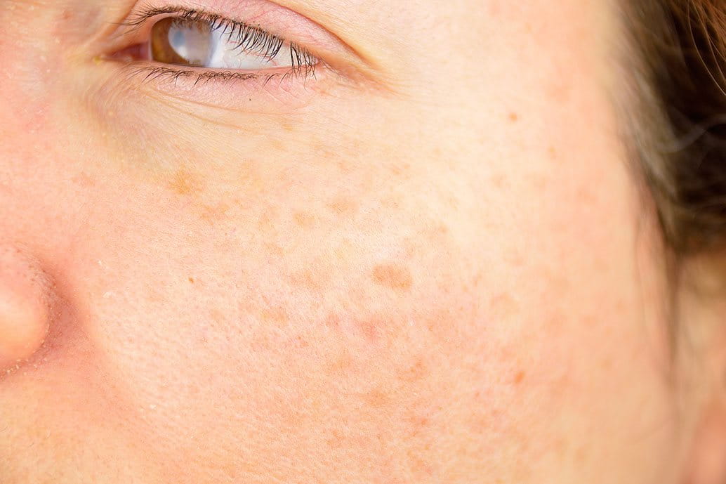  trattamento laser contro acne