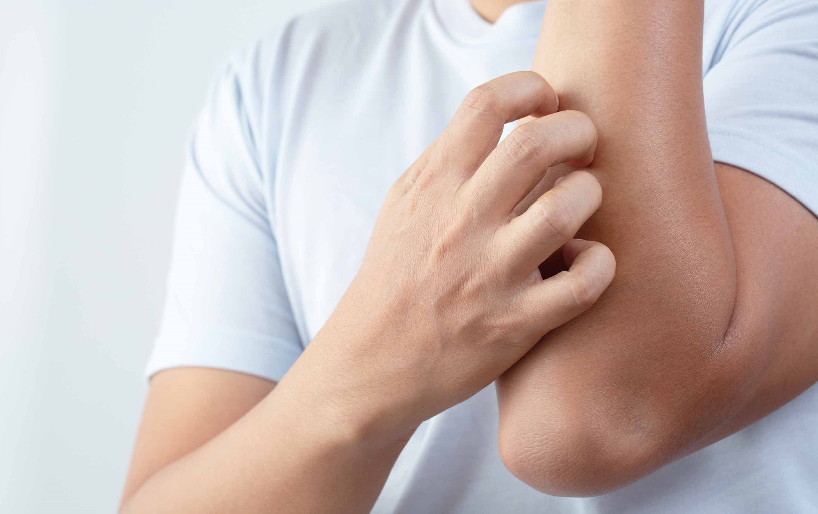 psioriasi da stress immagini 