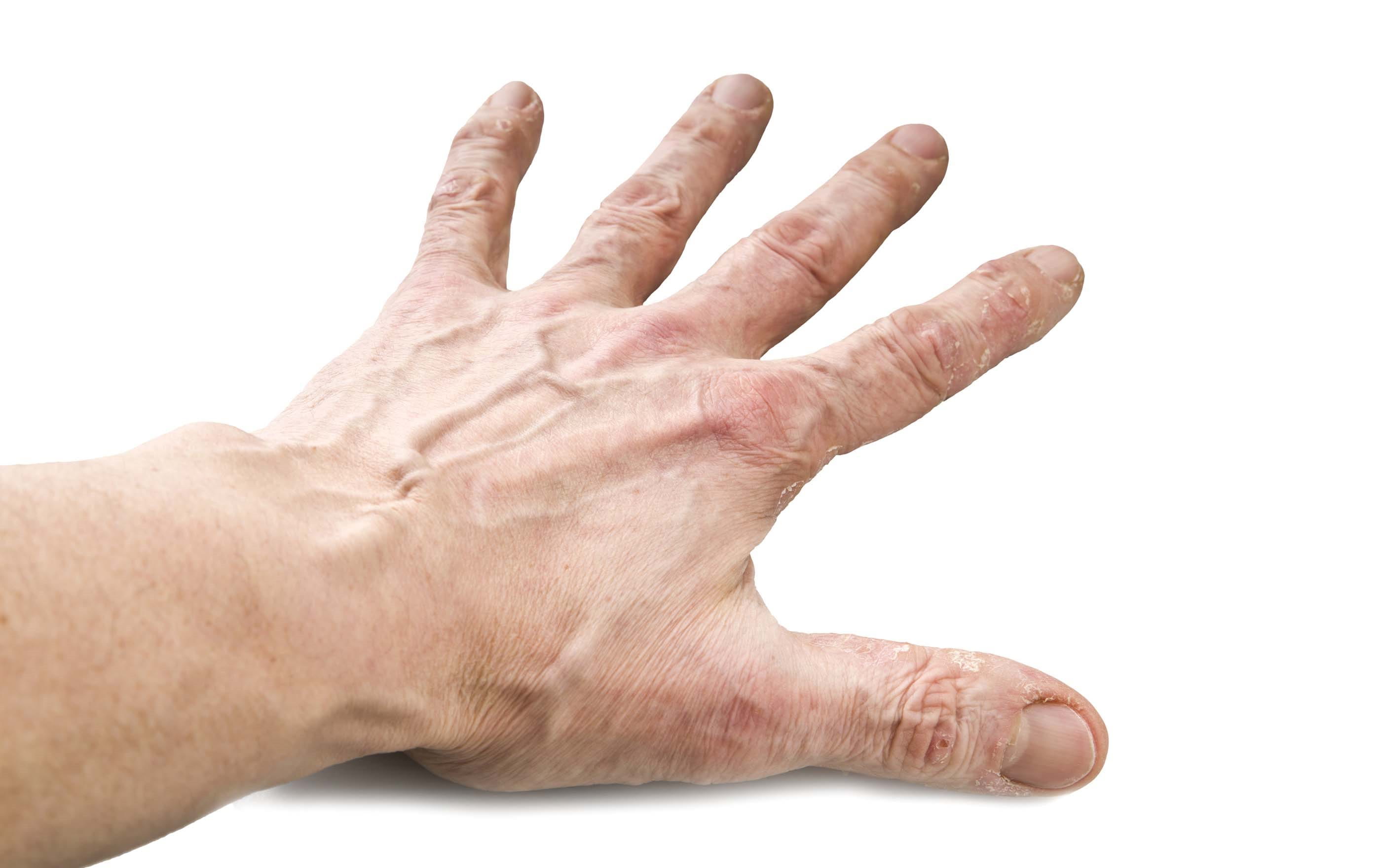 mani psoriasi da stress  