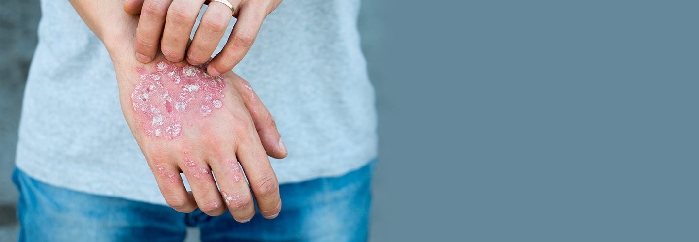 Foto di psoriasi sulle mani