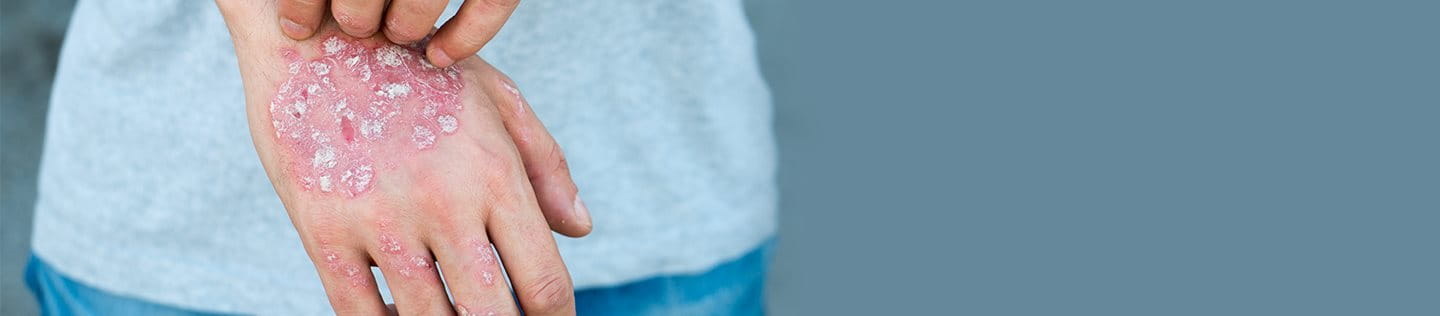 Foto di psoriasi sulle mani