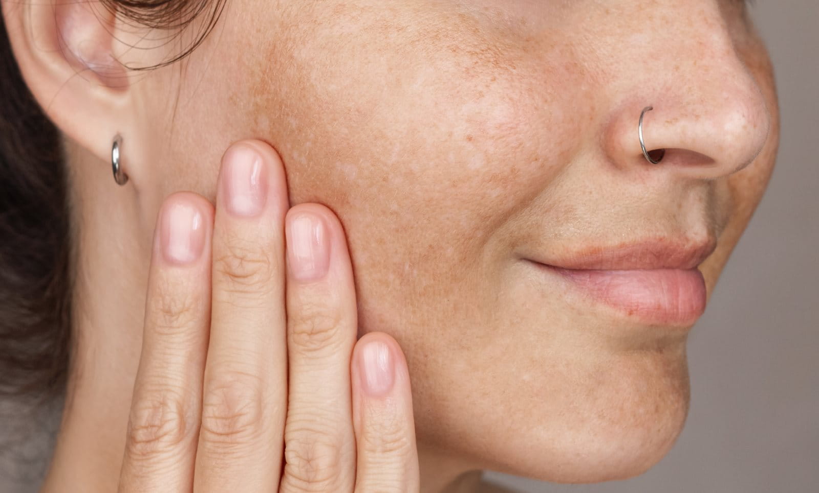 Melasma