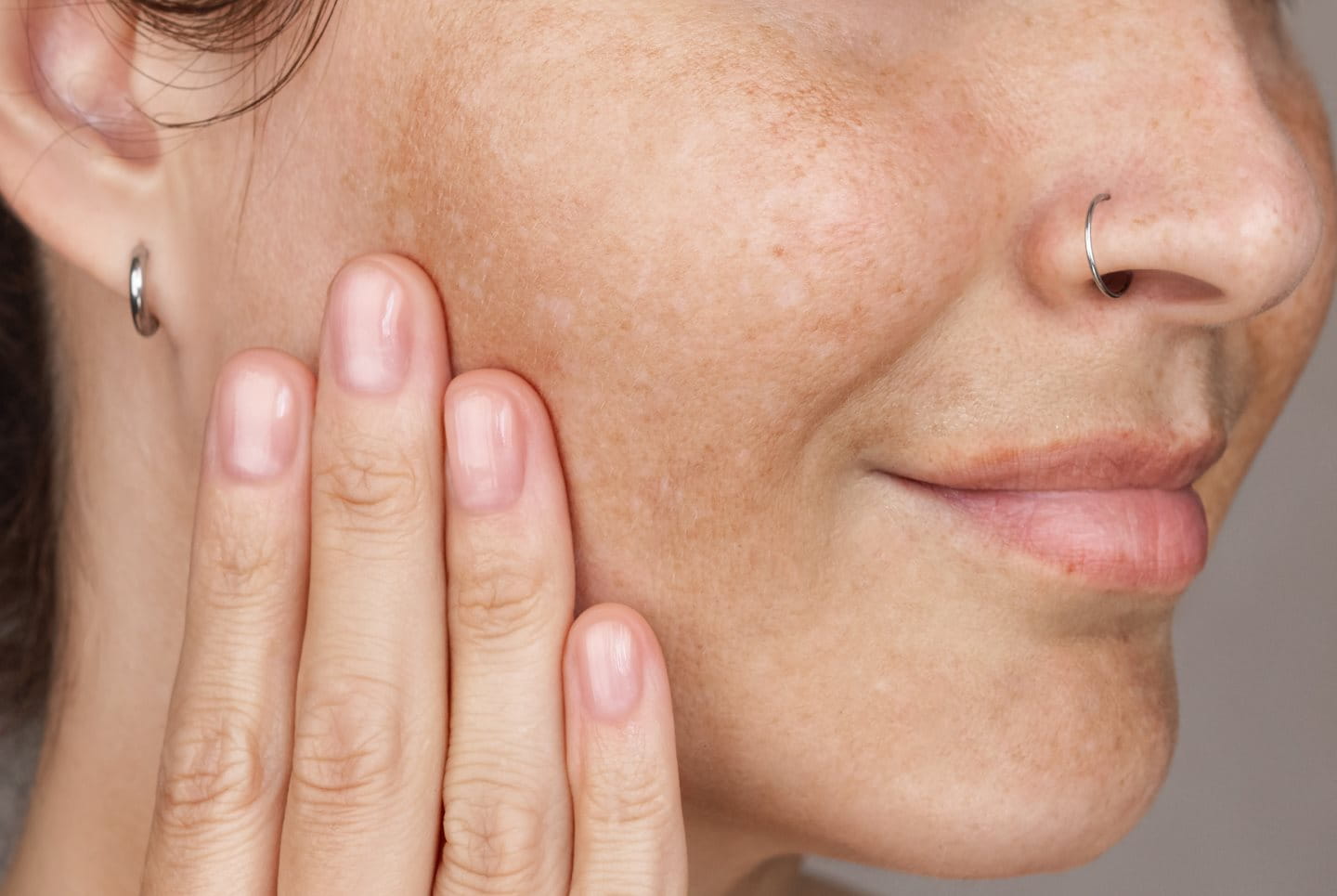 dark spots, skin, melasma, post acne marks